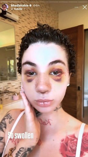 Last month in January, Bhad Bhabie revealed that she got a nose job amid her health battle - and later hit back at critics by sharing that the procedure was 'cleared by my doctor'