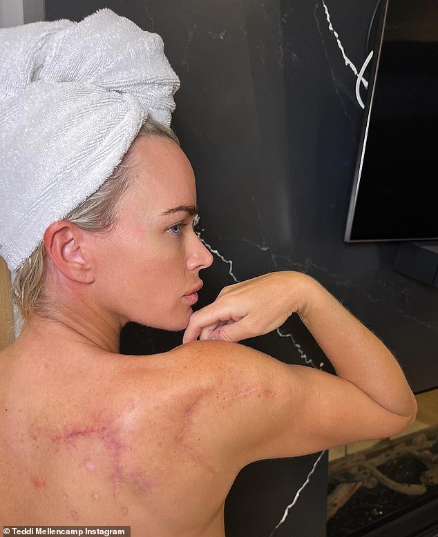 After trying the immunotherapy cream for almost two weeks, Teddi took to Instagram and penned, ''Melanoma Immunotherapy Update: It's been 12 days since I started the immunotherapy cream on my shoulder, and sadly it has not blistered yet'