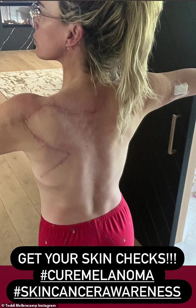 Teddi took to her Instagram page to share graphic photos following melanoma surgery as she prepared to undergo her 16th procedure to remove the disease