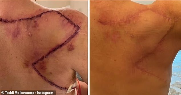 After the procedure, she updated her fans three months later to show the vast difference of how her large scar had healed