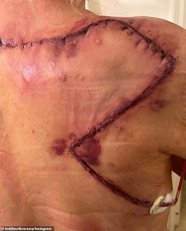 Days later, Teddi showed a large scar on her back following the surgery