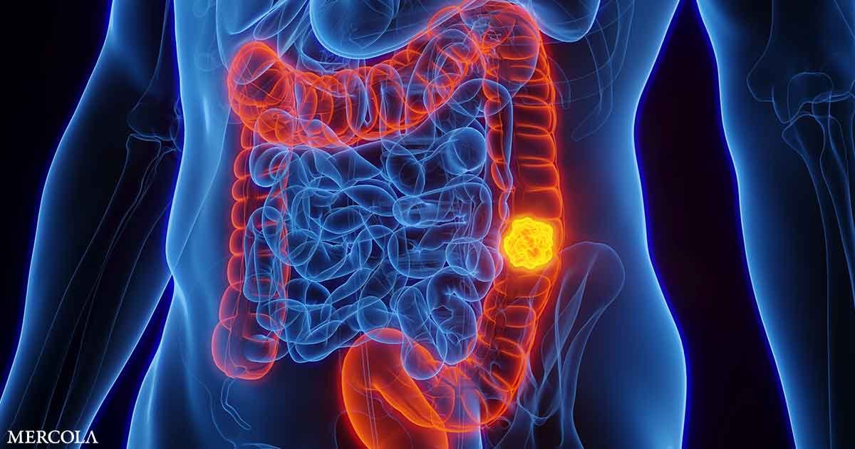 Gut Bacteria’s Hidden Role in Colon Cancer Risk